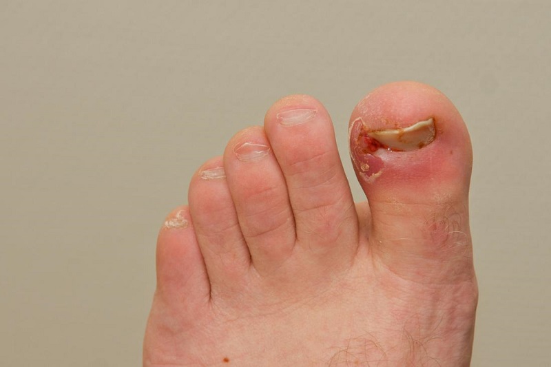 common nail diseases