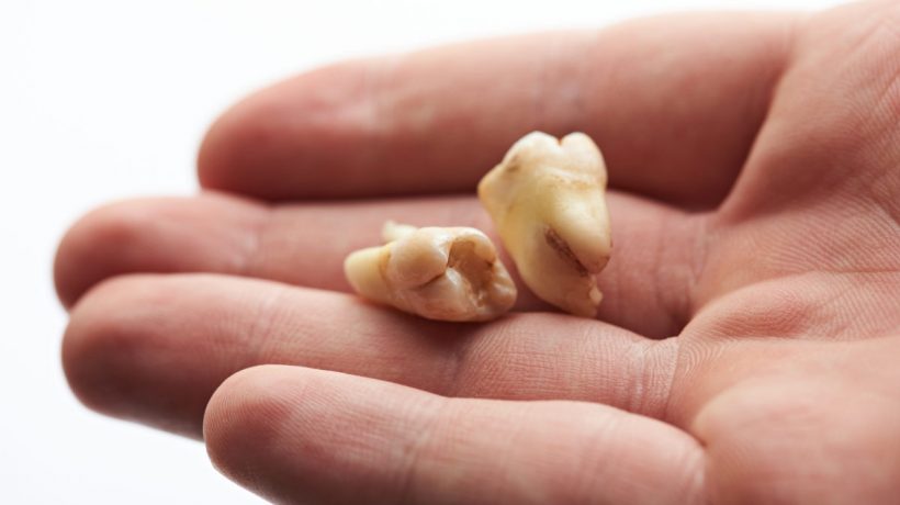 5 Ways to Prevent Common Tooth and Mouth Injuries