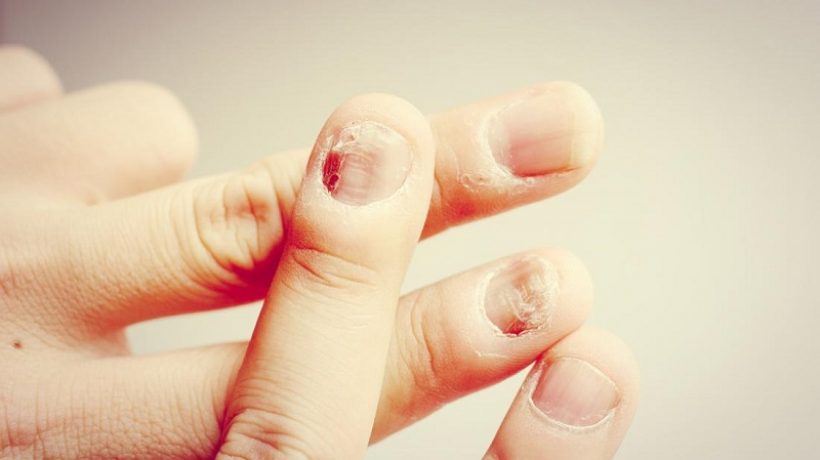 The 6 most common nail diseases